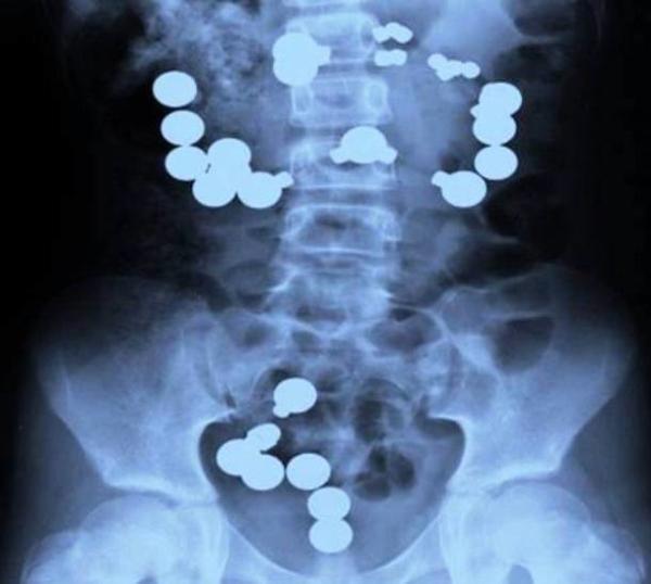 Ja vážne netuším ako sa to tam dostalo pán doktor !