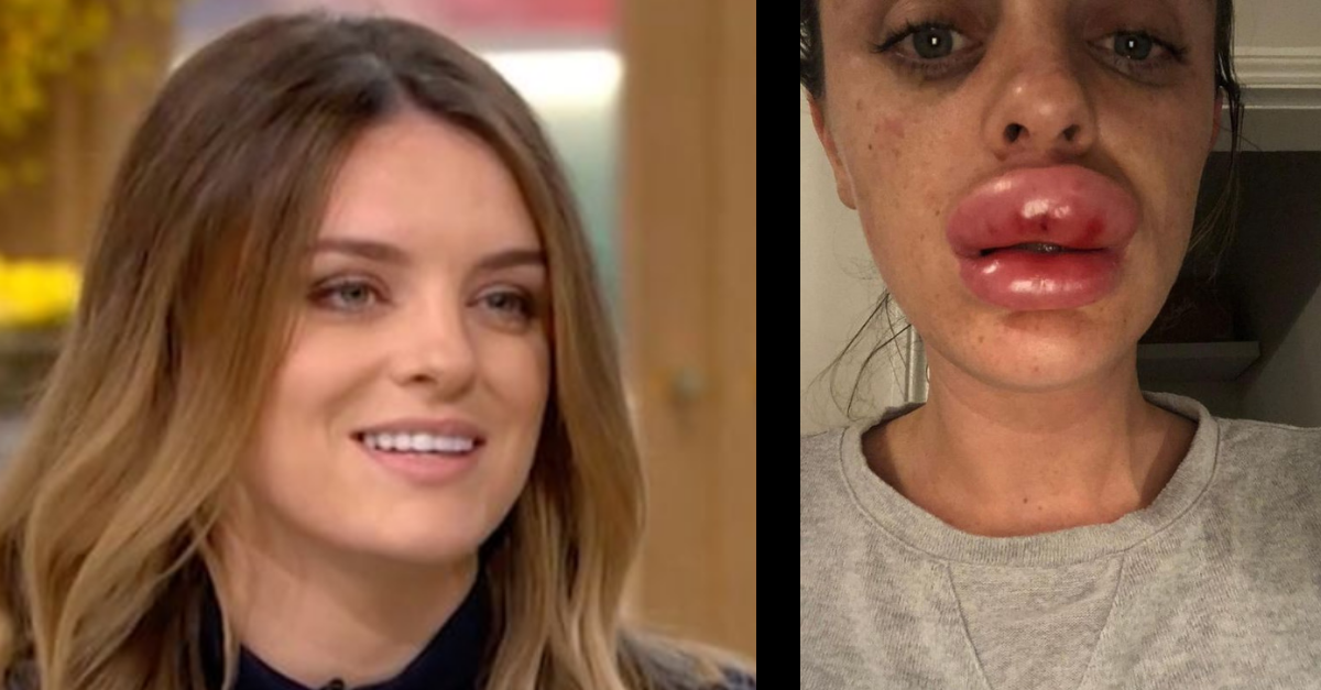 Žena si chcela vylepšiť pery vo vlastnej obývačke – horná pera jej skoro odpadla