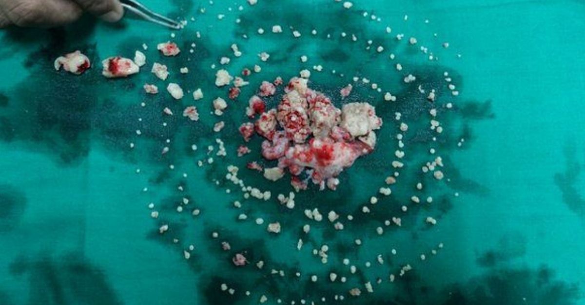 Malému chlapcovi odstránili z úst vyše 500 zubov potom ako sa sťažoval na bolesť v čelusti