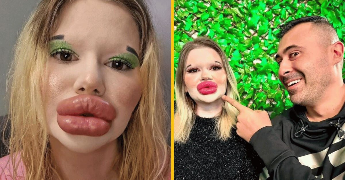 Zoznámte sa so ženou, ktorá chce mať najväčšie pery a lícne kosti na svete