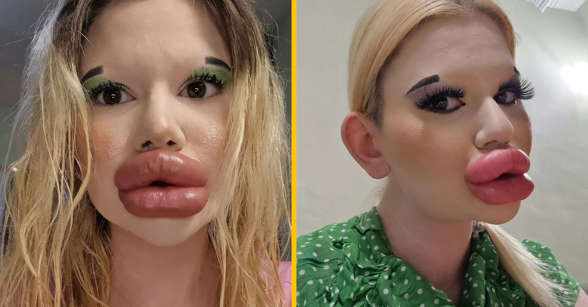 Žene s najväčšími perami to stále nestačí, chce svoju tvár „vylepšovať“ aj naďalej