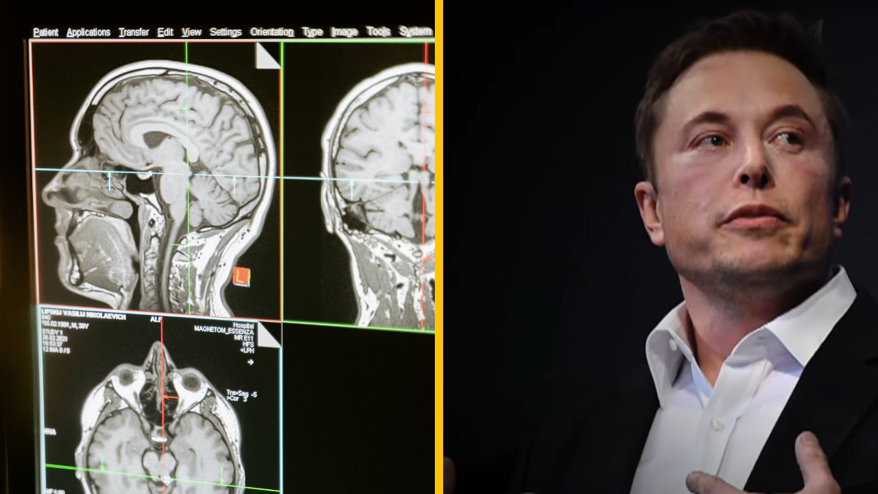 Kontroverzný startup Elona Muska implantoval prvý Neuralink čip do ľudského mozgu
