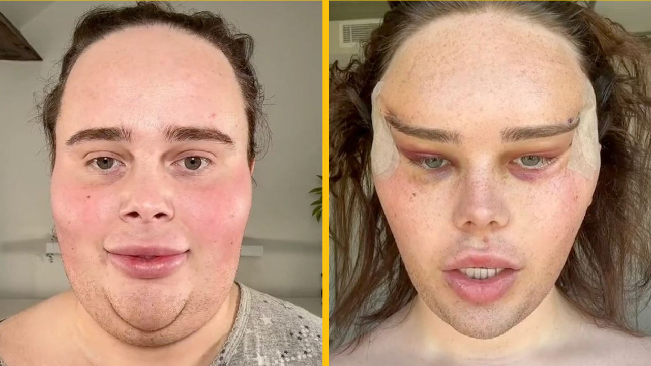 Influencerka odhalila dramatické výsledky svojej plastickej operácie
