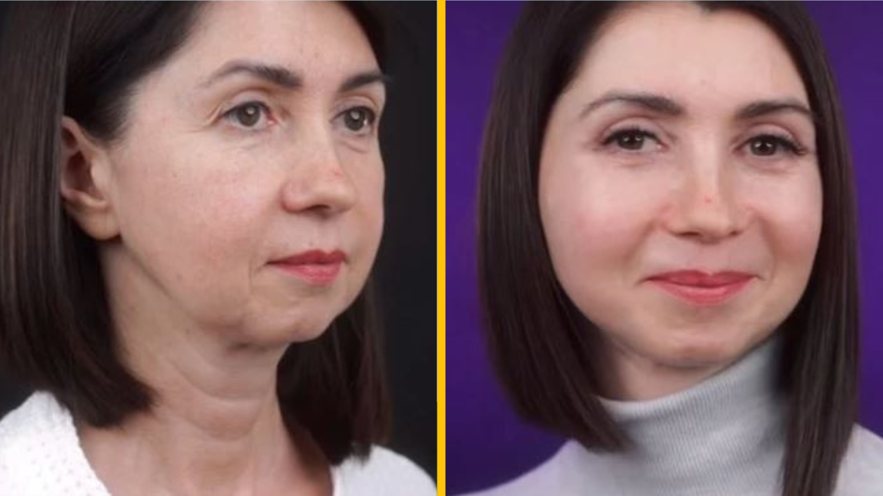 Žena (49) odhalila dramatické výsledky svojej omladzovacej operácie
