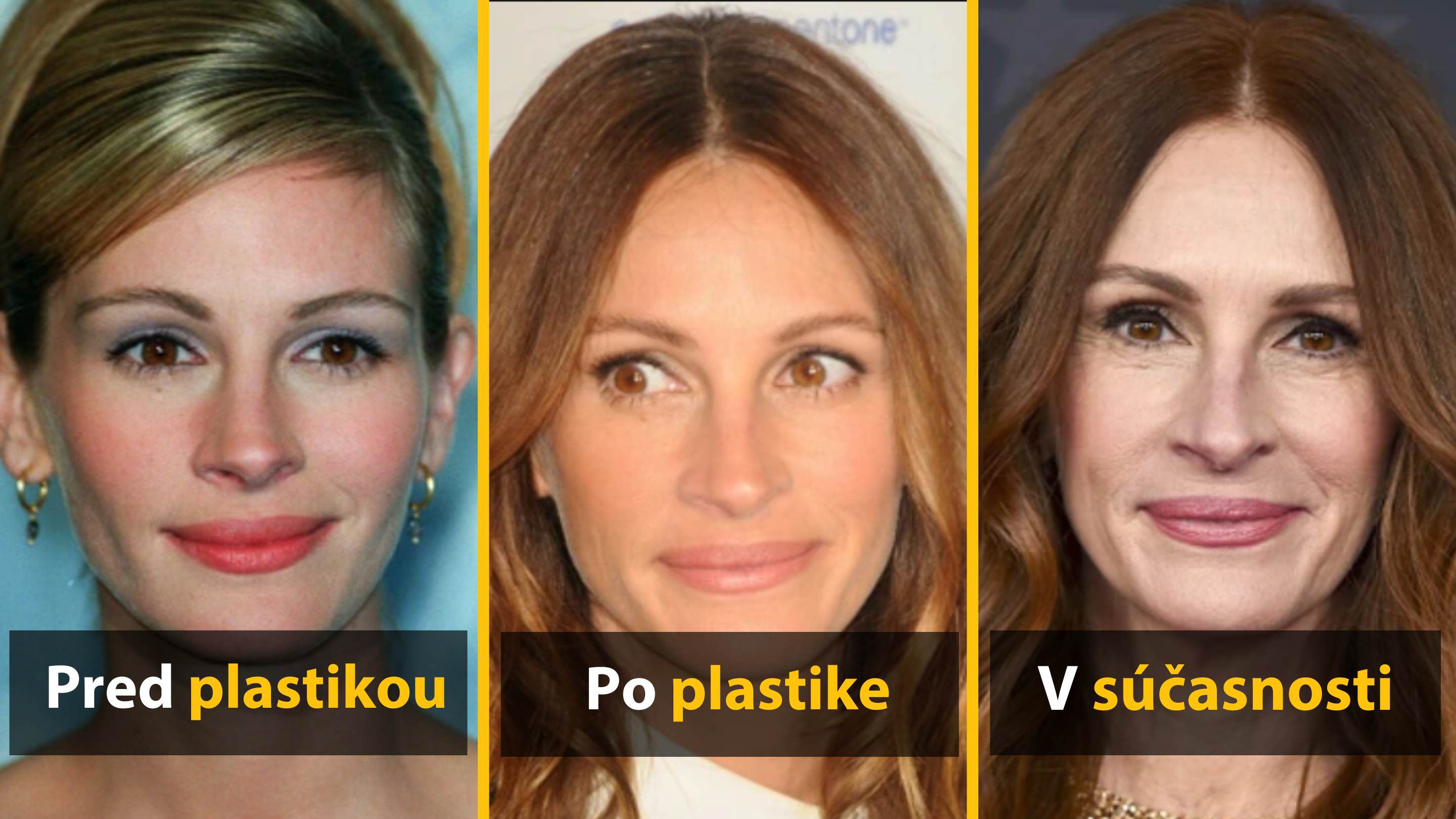 9 celebrít, ktoré oľutovali plastické operácie